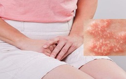 Cô gái mắc sùi mào gà sau nhiều lần quan hệ với bạn trai