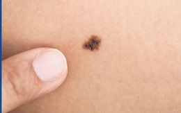 Sở hữu nốt ruồi ở những vị trí này, cuộc sống viên mãn, tình tiền hanh thông