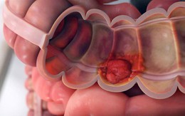 Cô gái 33 tuổi hối hận muộn màng vì sự chủ quan khiến ung thư lớn lên mỗi ngày