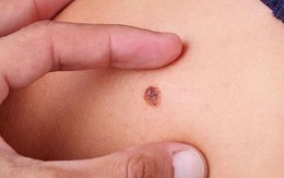 Người phụ nữ phát hiện ung thư da từ nốt đen dưới mắt, tồn tại nhiều năm mà không biết