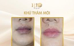 Hết thâm môi nhanh nhờ công nghệ khử thâm môi mới