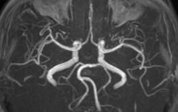 Nữ bệnh nhân đột quỵ bác sĩ chỉ ra nguyên nhân bất ngờ