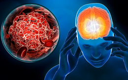 Người phụ nữ đột quỵ lúc nửa đêm có biểu hiện trước 10 ngày, nhưng dấu hiệu này nhiều người Việt rất dễ bỏ qua