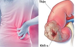 Người đàn ông 43 tuổi phát hiện ung thư thận, thừa nhận một sai lầm nhiều người Việt mắc phải