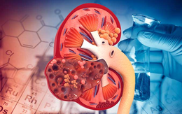 5 dấu hiệu suy thận sớm thường bị nhầm là do mệt mỏi, tuổi tác, người Việt nên biết để phòng bệnh