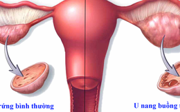 Phụ nữ cần đi khám phụ khoa định kỳ để phát hiện căn bệnh nguy hiểm, ít triệu chứng này