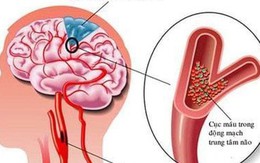 Sau đột quỵ, người bệnh bắt buộc phải uống những loại thuốc nào?