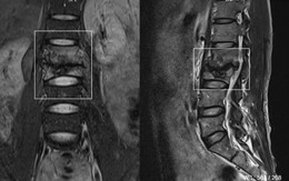 Đi khám vì đau lưng, người đàn ông 39 tuổi bất ngờ phát hiện bị tiêu 2 đốt sống