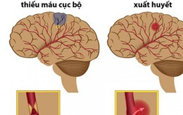 Có nên dùng An cung ngưu hoàng hoàn để phòng và điều trị đột quỵ?