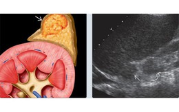 Nữ sinh 18 tuổi ở Hà Nội phát hiện u tuyến thượng thận từ một việc mà rất nhiều người Việt bỏ qua