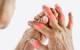 Biểu hiện cảnh báo khởi phát bệnh gút