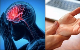 Cô gái 21 tuổi nguy kịch nhập viện vì đột quỵ, xuất huyết não, bác sĩ chỉ rõ nguyên nhân chính