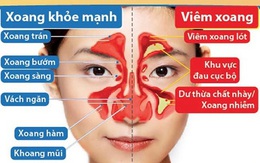 Cảnh báo nguy cơ viêm mũi xoang cấp từ một sai lầm nhiều người Việt mắc phải