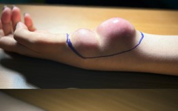 Đau cổ tay kéo dài, cô gái 23 tuổi bất ngờ phát hiện mắc ung thư
