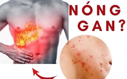 Mùa hè, 4 dấu hiệu cơ thể cảnh báo bạn đang bị nóng gan