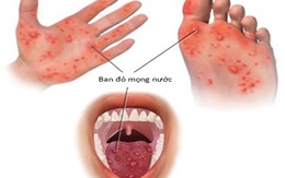 Bệnh tay chân miệng đang gia tăng, bố mẹ cần biết điều này để bảo vệ con