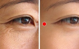 5 động tác đơn giản hằng ngày xóa mờ nếp nhăn đuôi mắt
