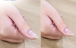 Đau ở ngón tay, bé 13 tuổi bất ngờ phát hiện bị u cuộn mạch, bác sĩ chỉ rõ có dấu hiệu này cần khám sớm