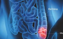 5 bí quyết giảm nguy cơ mắc ung thư đại tràng
