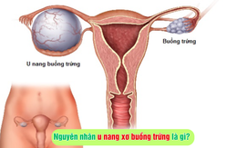 Nguyên nhân u nang xơ buồng trứng là gì?