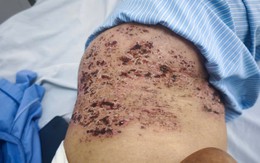 Người phụ nữ 73 tuổi nhập viện trong tình trạng đau đớn, tổn thương da nặng do sai lầm trong điều trị zona thần kinh nhiều người Việt mắc phải