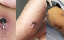Cảnh báo căn bệnh hiếm gặp xuất hiện ở Việt Nam