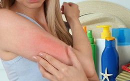 Cách xử trí khi bị dị ứng kem chống nắng