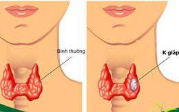 Người phụ nữ 60 tuổi cùng lúc mắc 2 thể ung thư tuyến giáp thừa nhận sai lầm nhiều người Việt mắc phải