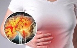 6 cách ngăn ngừa và kiểm soát bệnh gan nhiễm mỡ an toàn và hiệu quả
