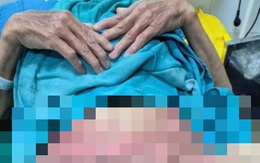 Tự điều trị viêm 'vùng kín', người phụ nữ ở Lạng Sơn bỏng nặng, lở loét toàn bộ vùng sinh dục