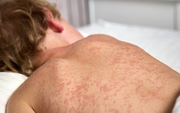 Cảnh giác với dấu hiệu bệnh sởi ở trẻ