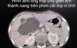 Bệnh viện Trẻ em Hải Phòng nội soi cắt nang ống mật chủ lớn cho bệnh nhi 10 tuổi