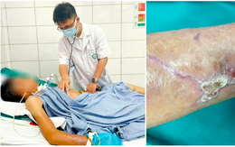 Người đàn ông 65 tuổi co giật, cứng hàm sau cú ngã đập tay vào thanh gỗ