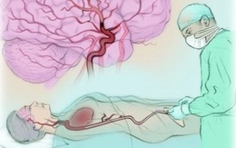 Người phụ nữ 57 tuổi đột quỵ liên tiếp 2 lần trong 2 ngày thừa nhận bỏ qua dấu hiệu báo bệnh này