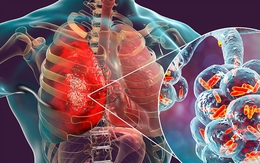 Bé 11 tuổi bất ngờ phát hiện ung thư phổi, nguyên nhân từ một sai lầm mà nhiều nam giới Việt mắc phải