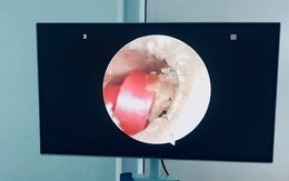Bé gái 6 tuổi đi viện do sợi dây chun buộc tóc