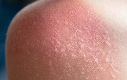 Cách khắc phục làn da bị cháy nắng