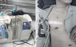 Thanh niên 25 tuổi ở Hà Nội nhập viện vì tràn khí màng phổi khi tập gym từng mắc bệnh này, ai có dấu hiệu cần cảnh giác!