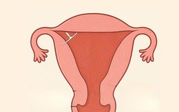 Vòng tránh thai 'đi lạc', cắm sâu vào cơ tử cung người phụ nữ sau 5 năm sử dụng