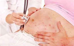 Mắc sởi khi mang thai, người phụ nữ 26 tuổi sinh non ở tuần 31