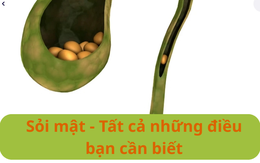 Sỏi mật - Tất cả những điều bạn cần biết