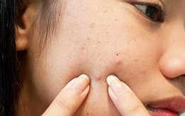 Sau nặn mụn không nên ăn gì?