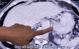 Người đàn ông bất ngờ phát hiện bị ung thư biểu mô từ dấu hiệu nhiều người Việt bỏ qua