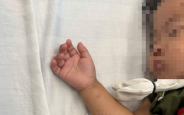 Bé gái hơn 2 tuổi nhập viện gấp do tai nạn tại nhà hay gặp ở trẻ nhỏ
