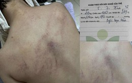 Bộ Y tế vào cuộc vụ bé gái 4 tuổi nghi bị cô giáo đánh đập, ném vào tường ở trường mầm non