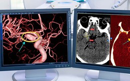 Người phụ nữ đột quỵ trong đêm từng có tiền sử mắc bệnh này