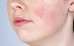 7 tác dụng phụ thường gặp khi sử dụng retinol và cách phòng ngừa