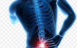 Cô gái 23 tuổi suýt liệt chân vì điều trị thoát vị đĩa đệm sai cách
