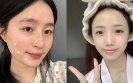 Làn da li ti mụn đã được cải thiện hoàn toàn nhờ 5 chiêu đơn giản