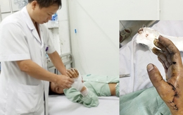 Học chế pháo theo hội nhóm trên mạng, trẻ suýt mất bàn tay